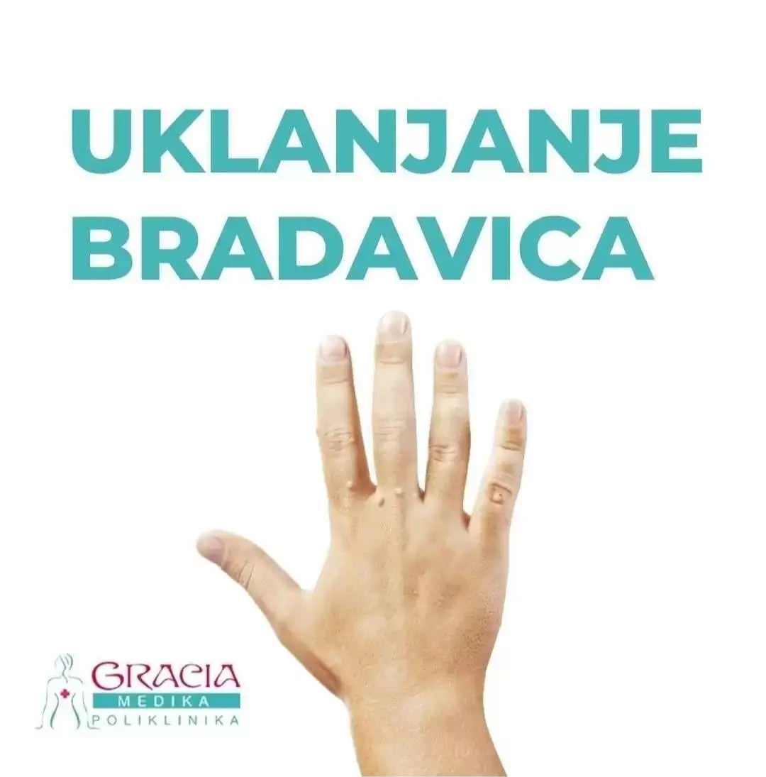 Uklanjanje Bradavica Beograd