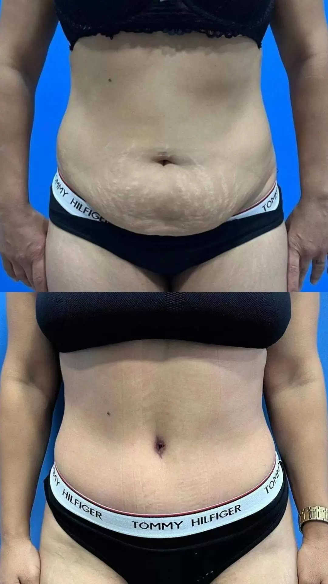 abdominoplastika