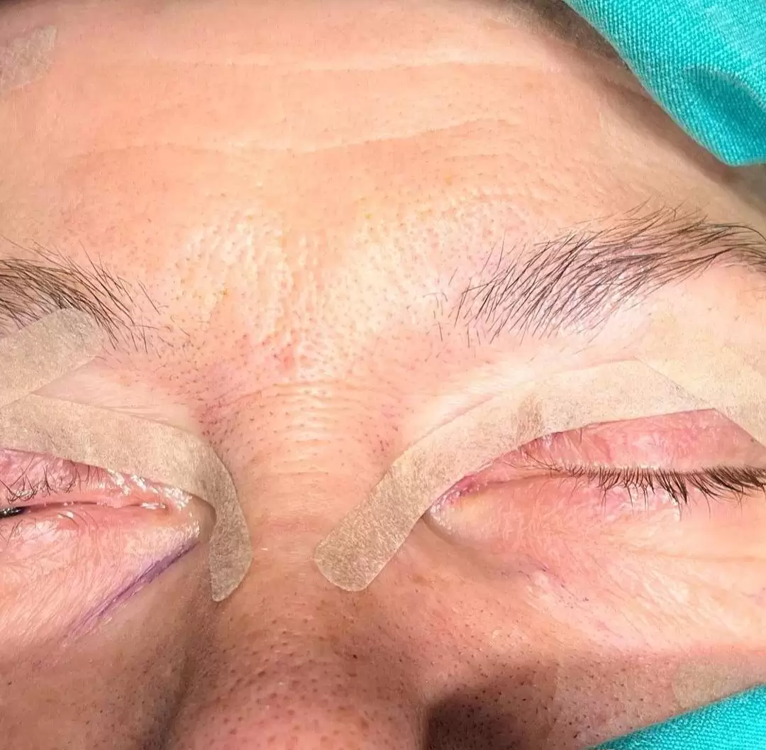 Blefaroplastika